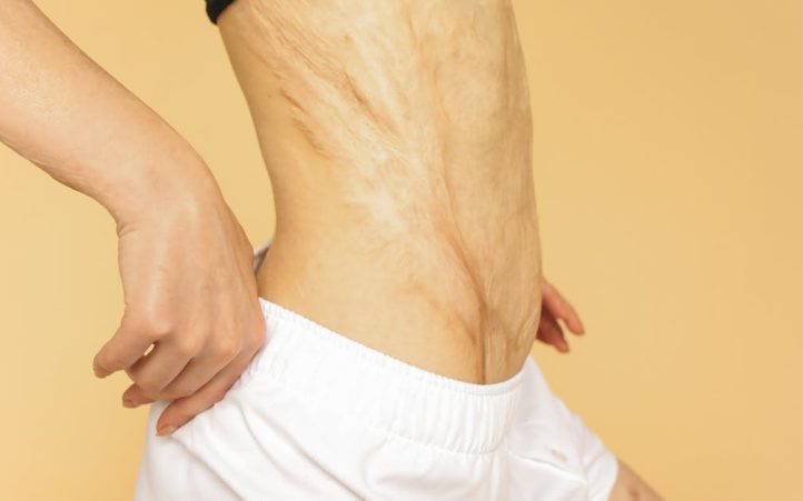 découvrez tout ce que vous devez savoir sur les vergetures : causes, prévention et traitements pour améliorer l'apparence de votre peau. informez-vous sur les meilleures pratiques pour prendre soin de votre peau et atténuer les vergetures.